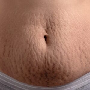 Rejuvenecimiento de Estrías – Área Abdomen
