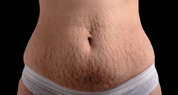 Rejuvenecimiento de Estrías – Área Abdomen