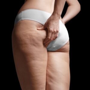 Rejuvenecimiento de Estrías – Área Posterior de los muslos (Atrás)